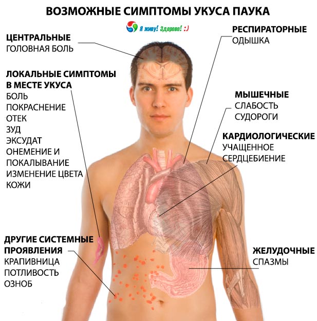 Симптомы укуса ядовитого паука Симптомы укуса ядовитого паука